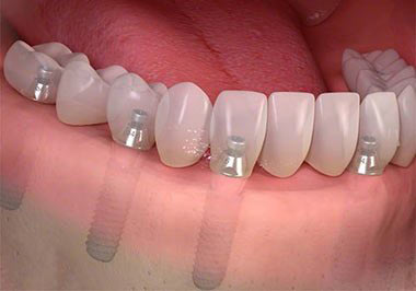 Dental Implants in Bronx