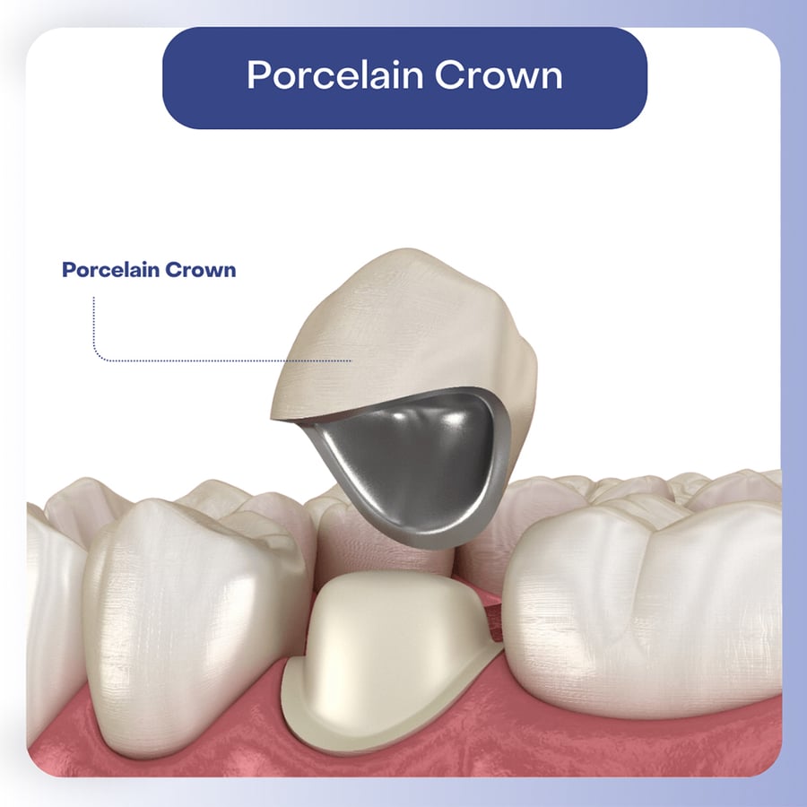 Dental Crowns