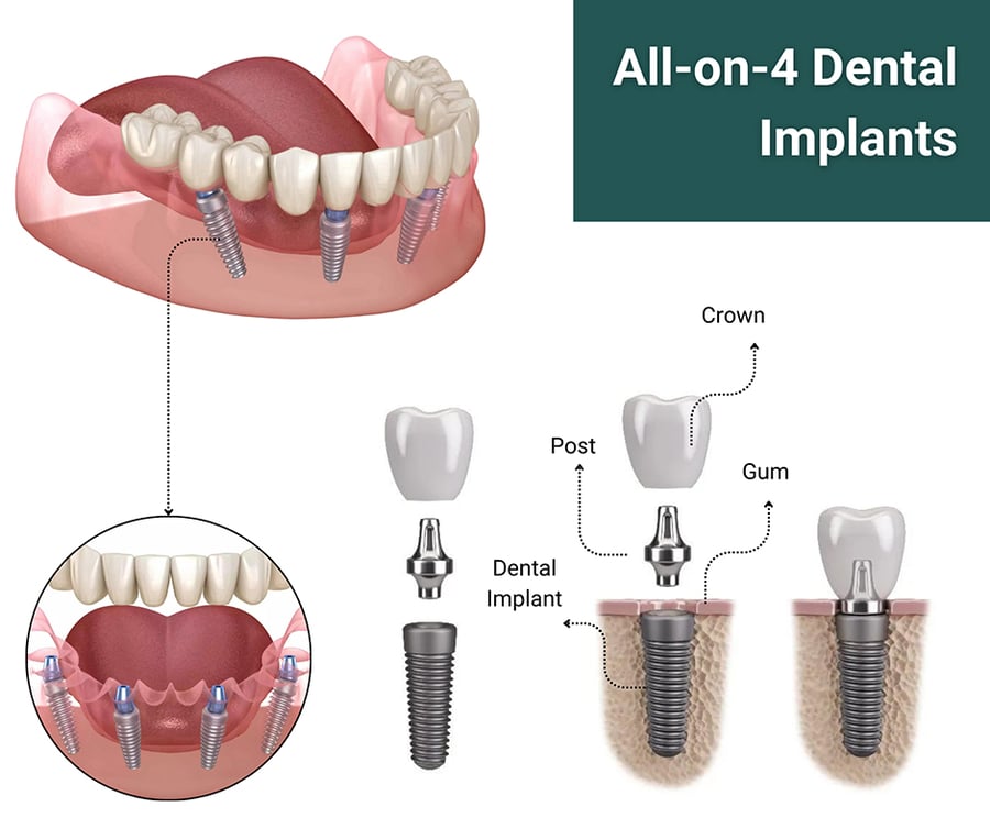 All-on-4 Dental Implants in New Jersey