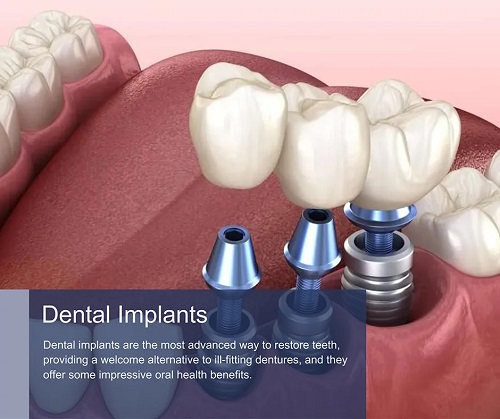 Affordable Dental Implants in Midtown Manhattan & Downtown Brooklyn