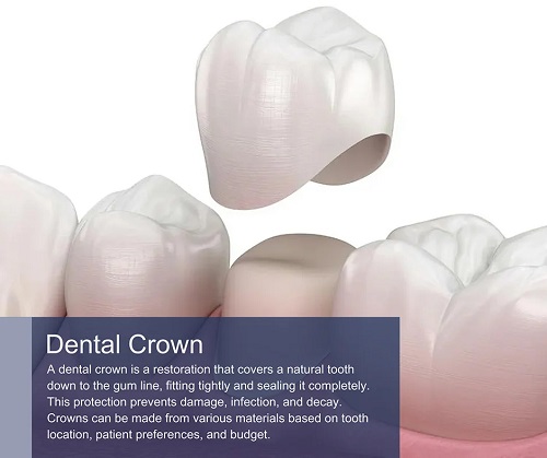 Dental Crowns in Midtown Manhattan & Downtown Brooklyn