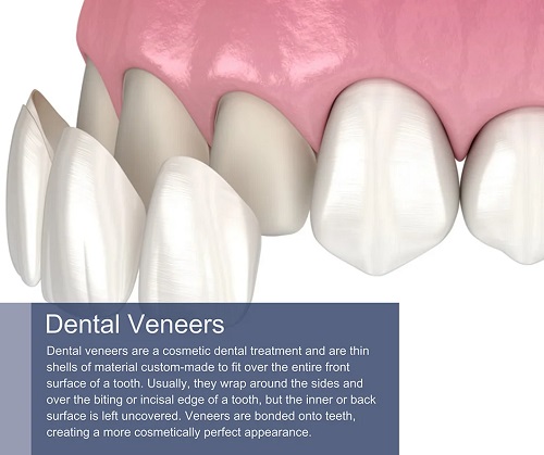 Dental Veneers (Porcelain Veneers Teeth) in Midtown Manhattan & Downtown Brooklyn