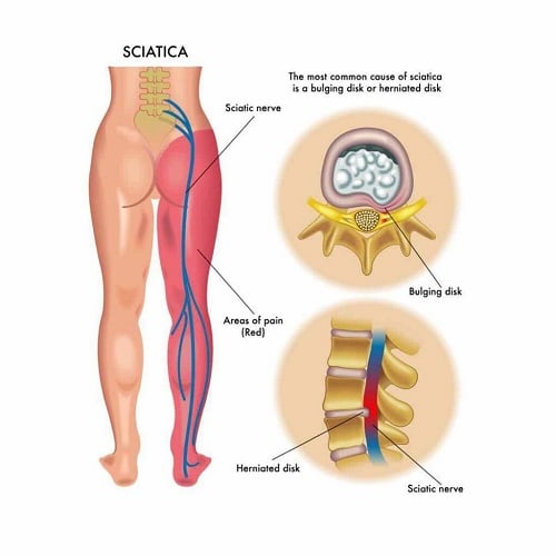 Sciatica Doctor Irving, TX – Sciatic Nerve Pain Specialist in Dallas, TX