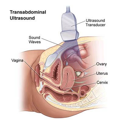 Pelvic Sonogram