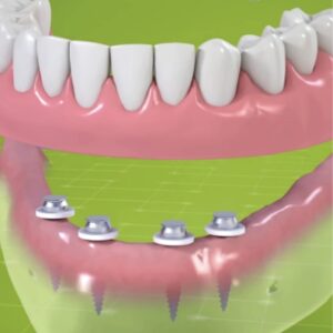 Mini Dental Implants NYC