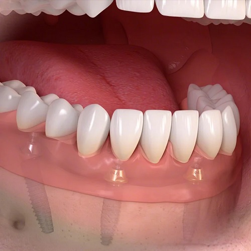 NYC All-on-4 Dental Implants