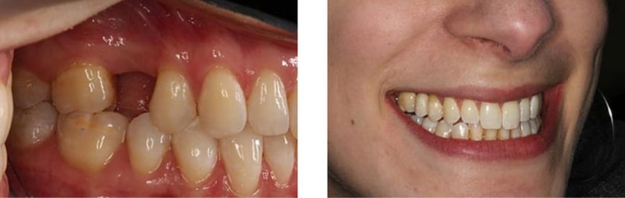 Dental Implants in Midtown, NYC