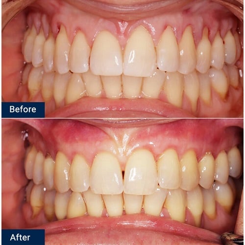 Gum Grafting Procedure