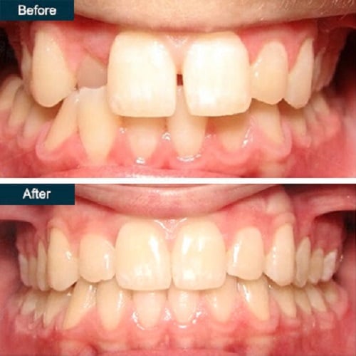 Invisalign® in Yonkers NY