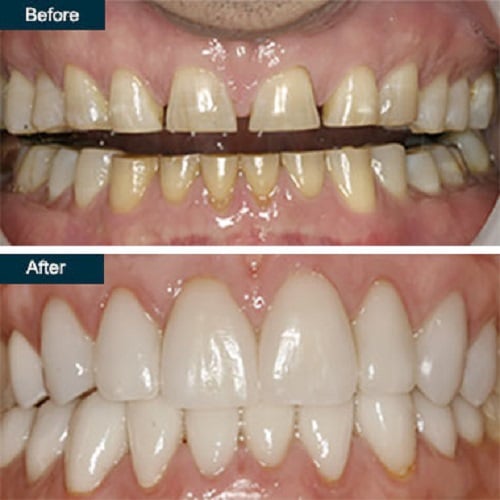 Porcelain Dental Veneers in Yonkers