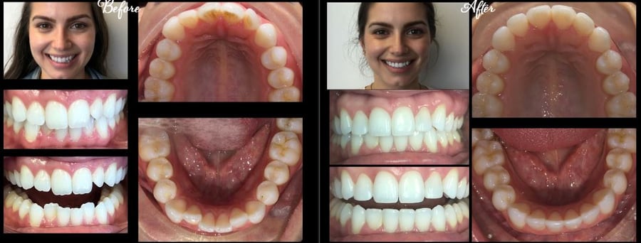 Invisalign in Stamford, CT