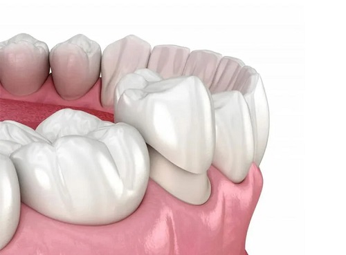 Porcelain and Zirconia Dental Crowns NYC