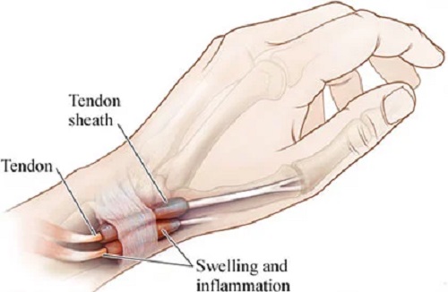 Wrist Pain Treatment in New York City
