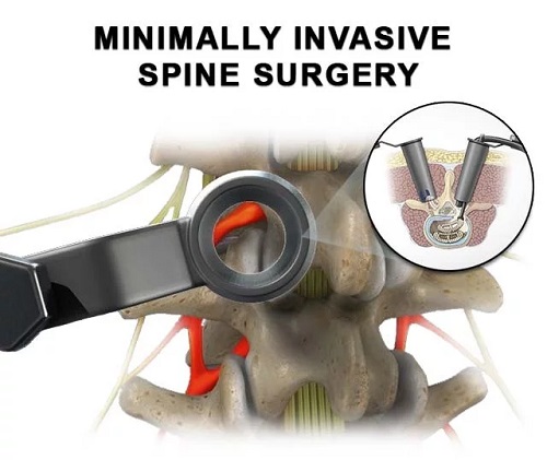 Minimally Invasive Spine Surgery in NYC