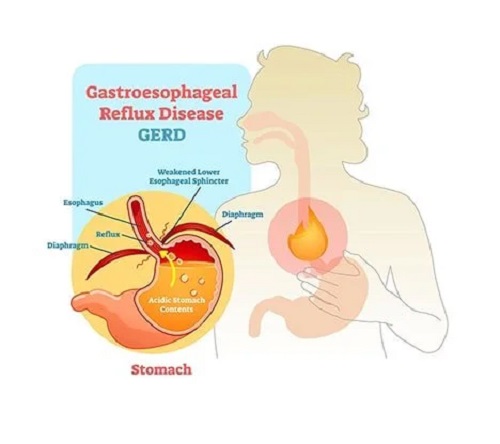 Acid Reflux Treatment Specialists New York