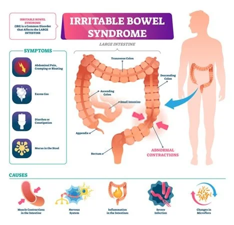 Irritable Bowel Syndrome (IBS) Specialist in NYC