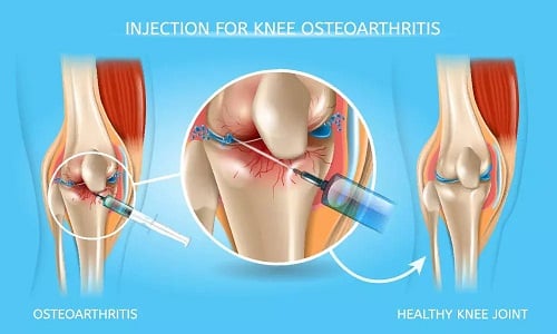 Knee Pain Treatment Specialists in Brooklyn & Manhattan