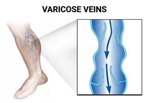 Varicose Veins Removal Doctor in Brooklyn, NY and Bronx, NY