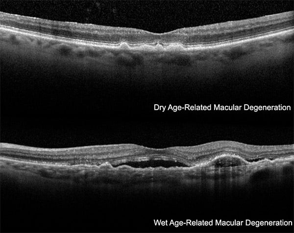 Macular Hole