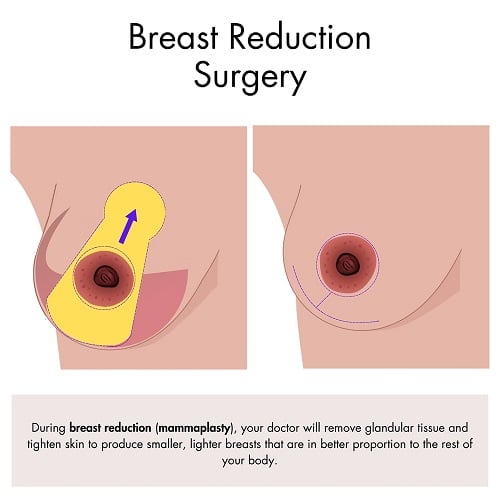 Breast Reduction in New Jersey