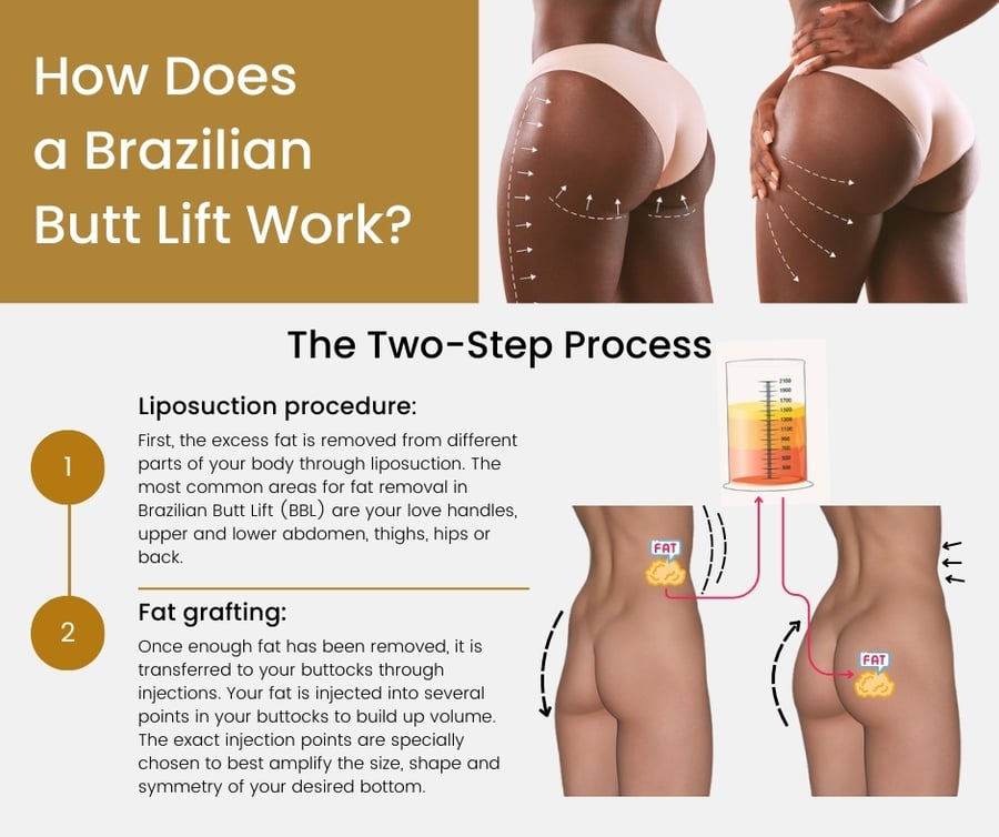 Brazilian Butt Lift in NYC -Awake BBL Manhattan & Bronx, NY