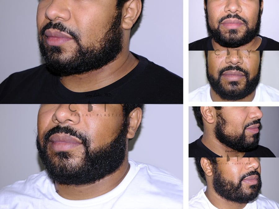 Beard Transplant