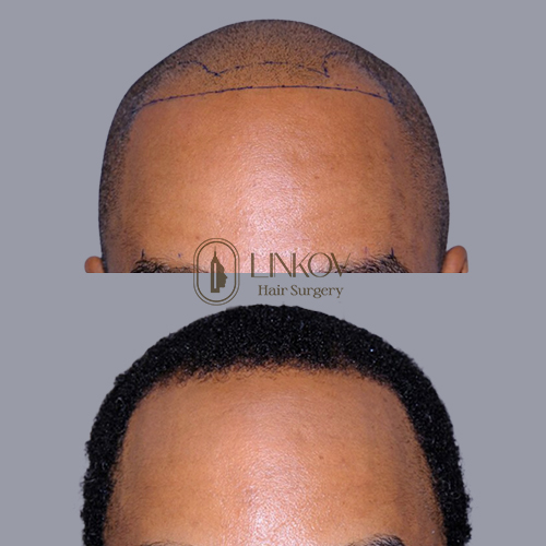 Hair Transplants